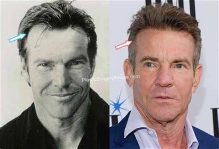 Get The Scoop: Dennis Quaid's Surgery And Recovery